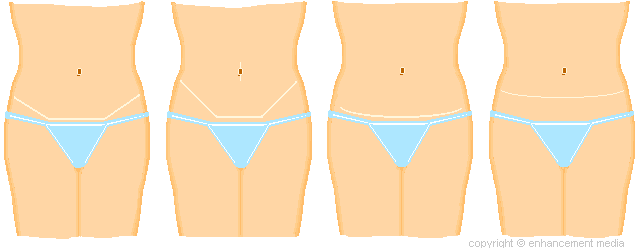 Standard full abdominoplasty scars